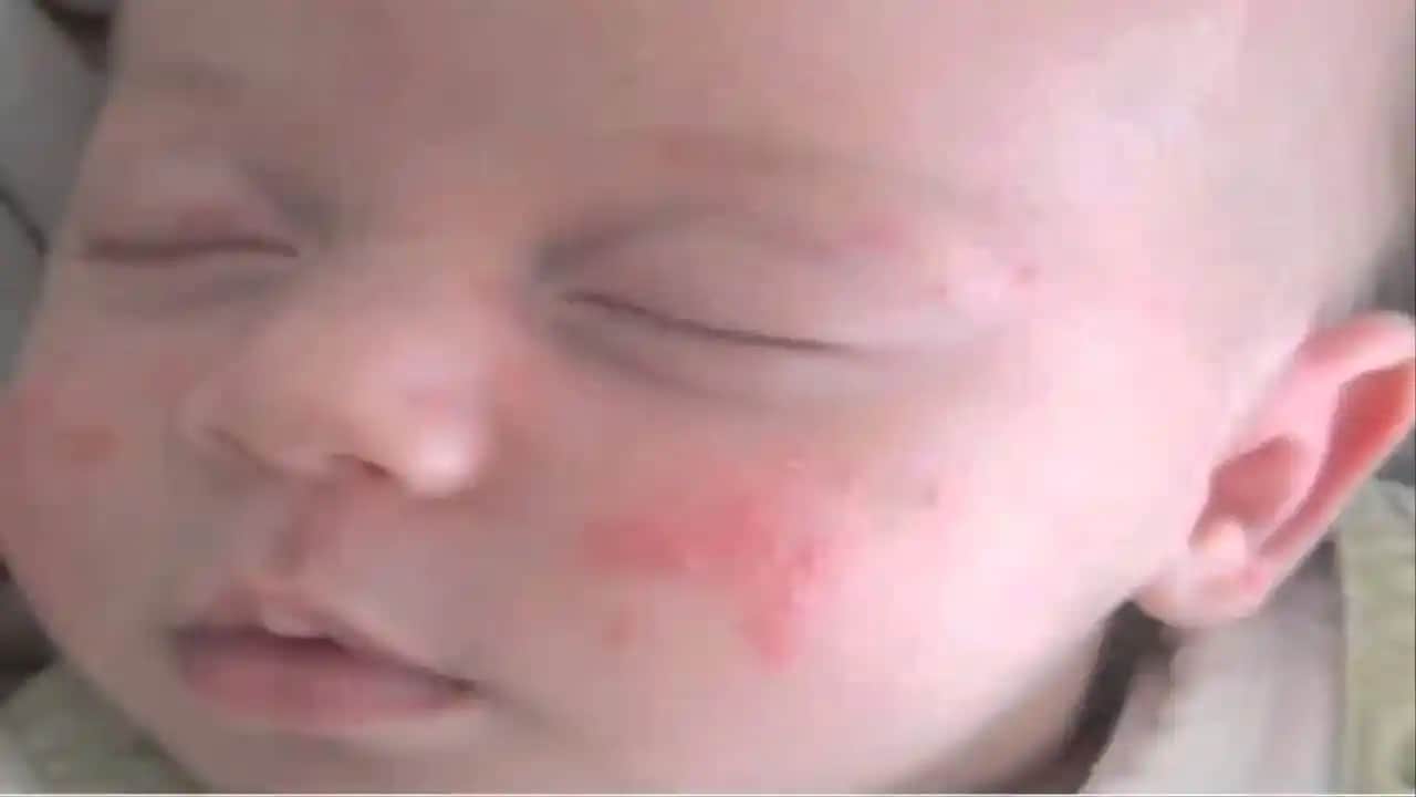 Bebeklerde Sivilce ve Kızarıklıkların Nedenleri ile Doğru Bakım Yöntemleri