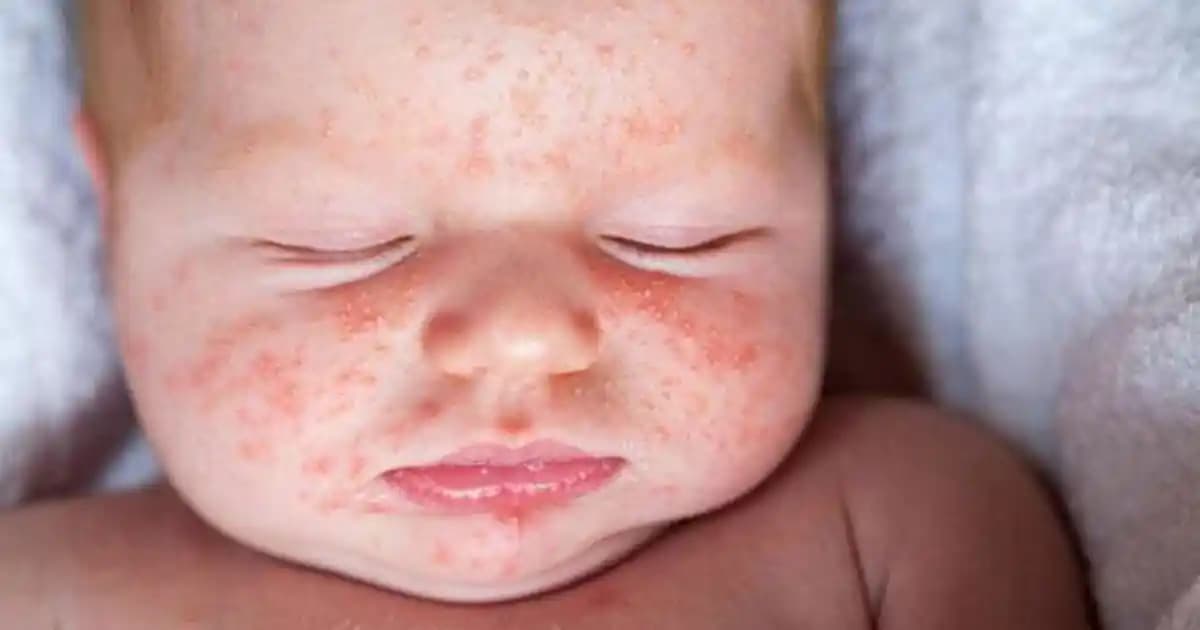 Bebeklerde Surat Kızarıklıklarının Nedenleri ve Etkili Çözüm Yöntemleri
