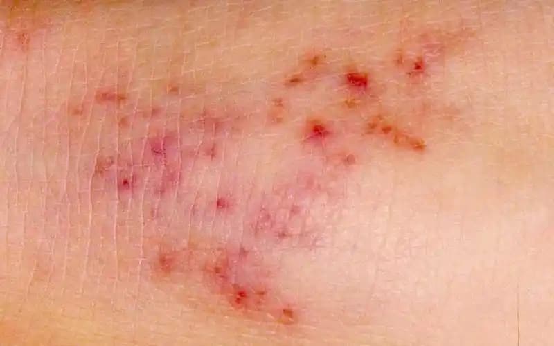 Bebeklerde Vücutta Çıkan Yaraların Nedenleri ve Uygun Bakım Yöntemleri