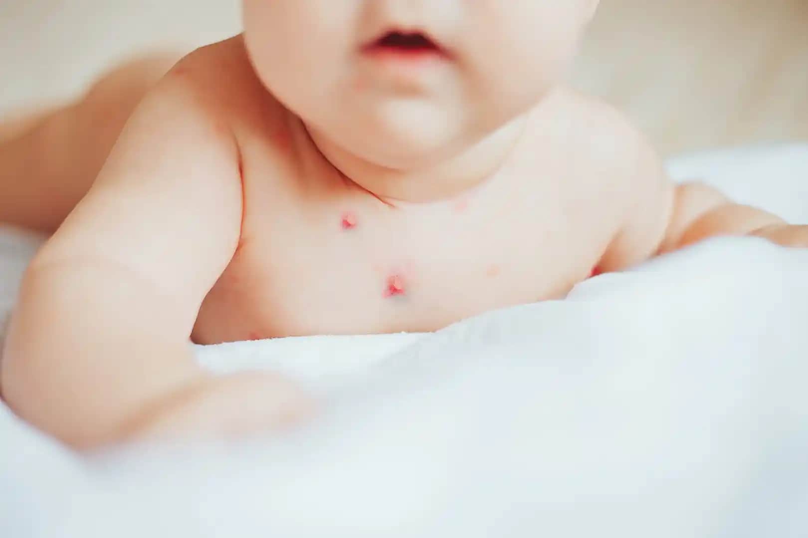 Bebeklerde Yanak Sivilcesi Nedenleri Belirtileri ve Bakım Yöntemleri