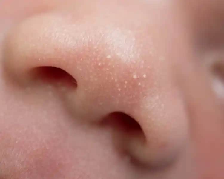 Bebeklerde Yüzde Beyaz Lekelerin Nedenleri Tanısı ve Tedavi Yöntemleri