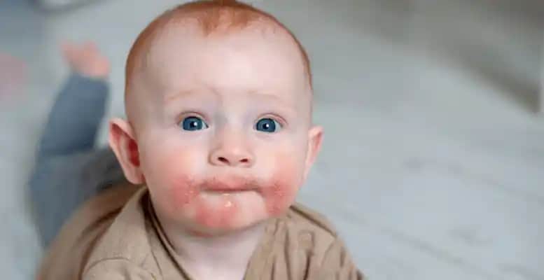 Bebeklerde Yüzde Kızarıklık ve Kuruluk: Nedenleri ve Etkili Bakım Yöntemleri