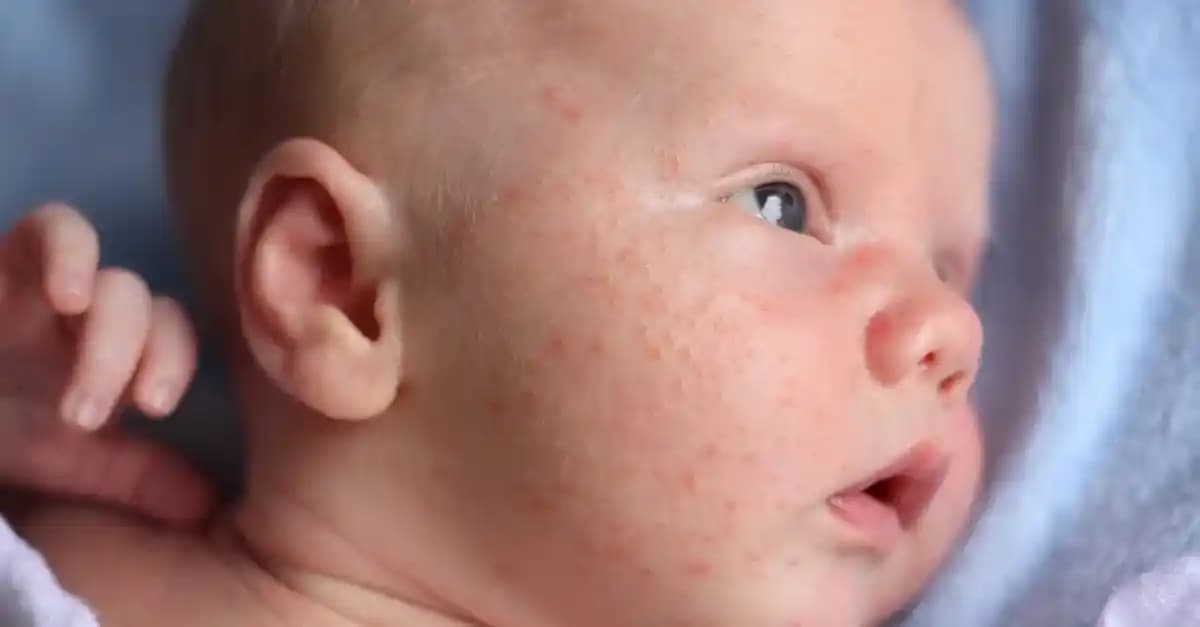 Bebeklerin Yüzünde Çıkan Sivilceler: Nedenleri, Belirtileri ve Bakım Yöntemleri