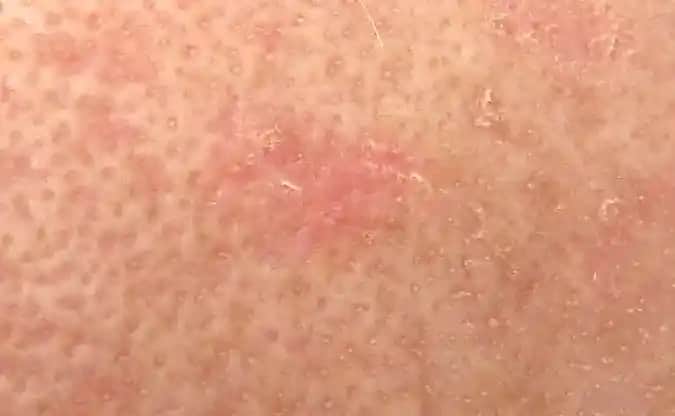 Burnun Üstünde Kırmızı Leke Nedenleri, Tedavi Yöntemleri ve Estetik Yaklaşımlar