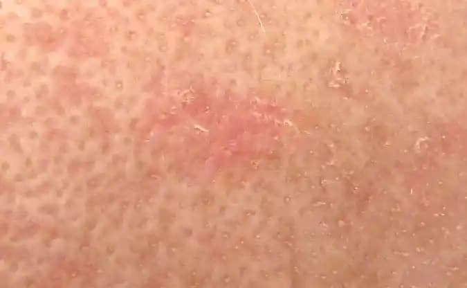 Burnun Üstünde Kırmızı Leke Nedenleri, Tedavi Yöntemleri ve Estetik Yaklaşımlar