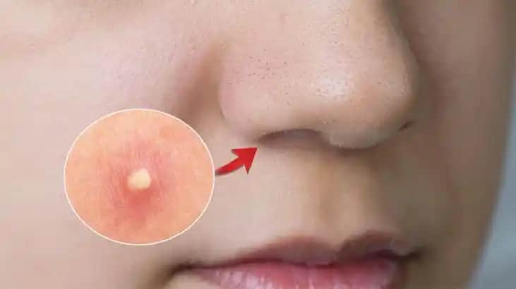 Burun Altı Sivilcesi: Nedenleri, Tedavi Yöntemleri ve Önleyici İpuçları