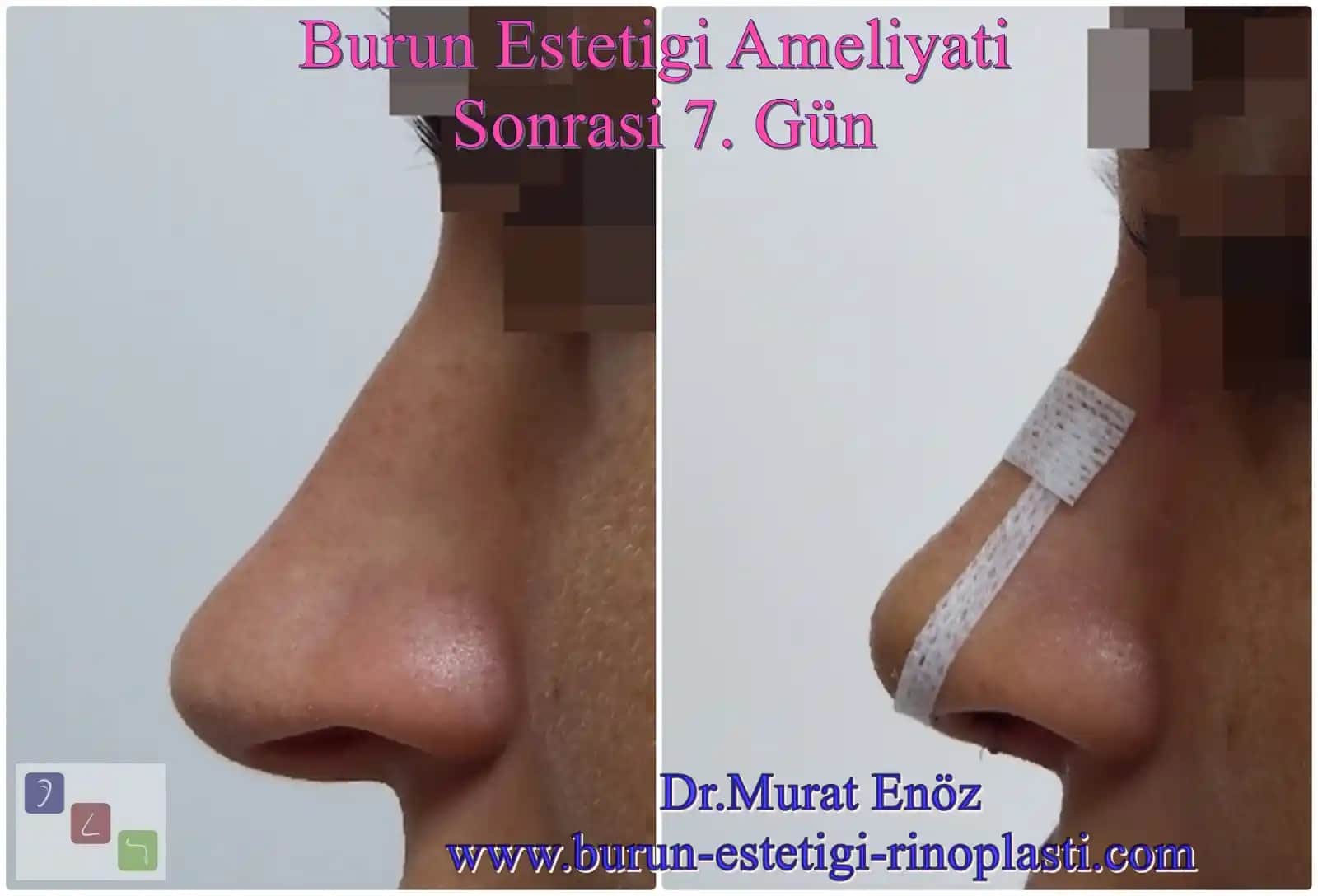 Burun Ameliyatı Sonrası Dikiş İzleri Nasıl Azaltılır ve Gelişmiş Yöntemler Nelerdir?