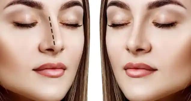 Burun Dikiş İzleri Nasıl Azaltılır ve Estetik Görünüm İçin Uygulanabilecek Yöntemler