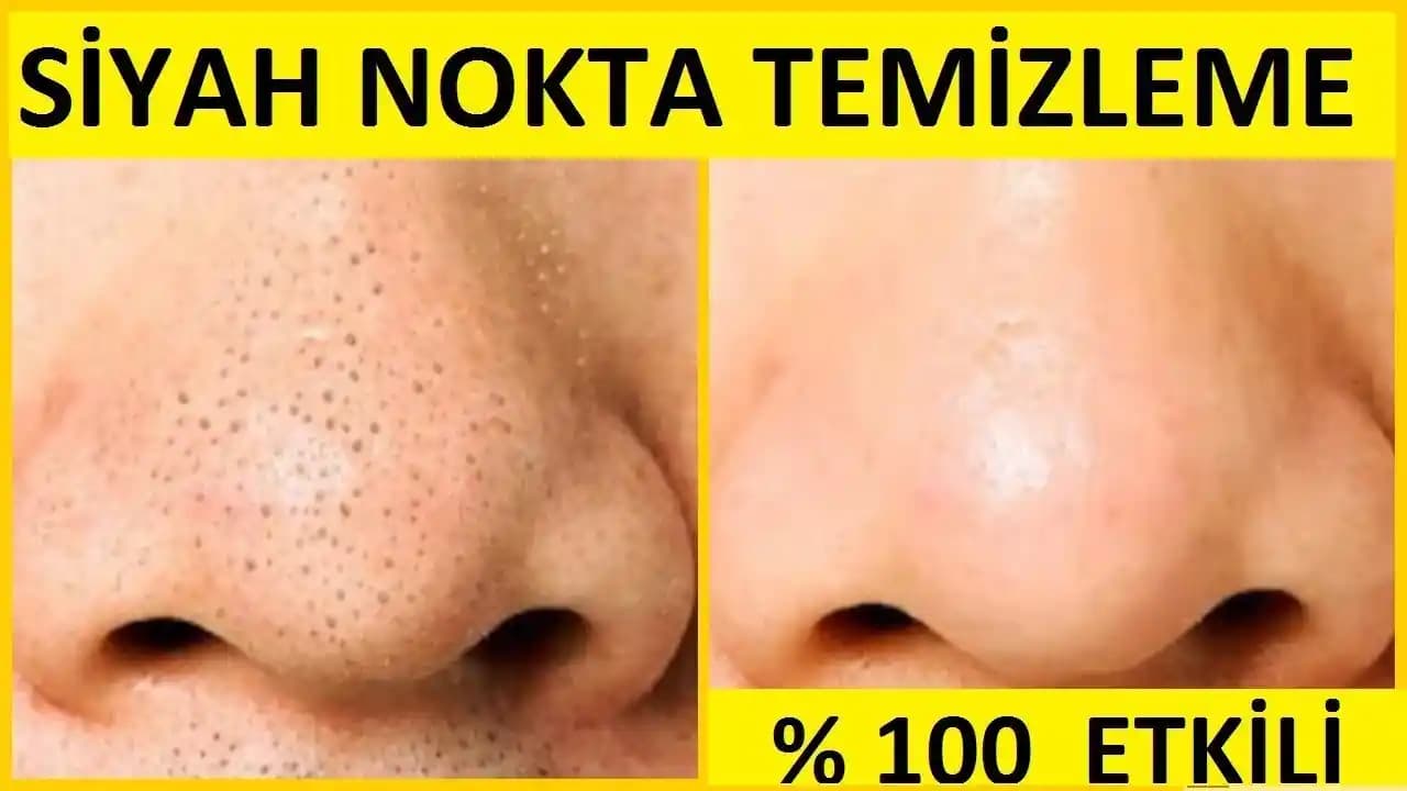 Burun Gözenekleri Nasıl Temizlenir Cilt Sağlığı İçin En Etkili Yöntemler