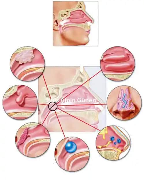 Burun İçi İltihabı Nedenleri Belirtileri ve Doğal Tedavi Yöntemleri