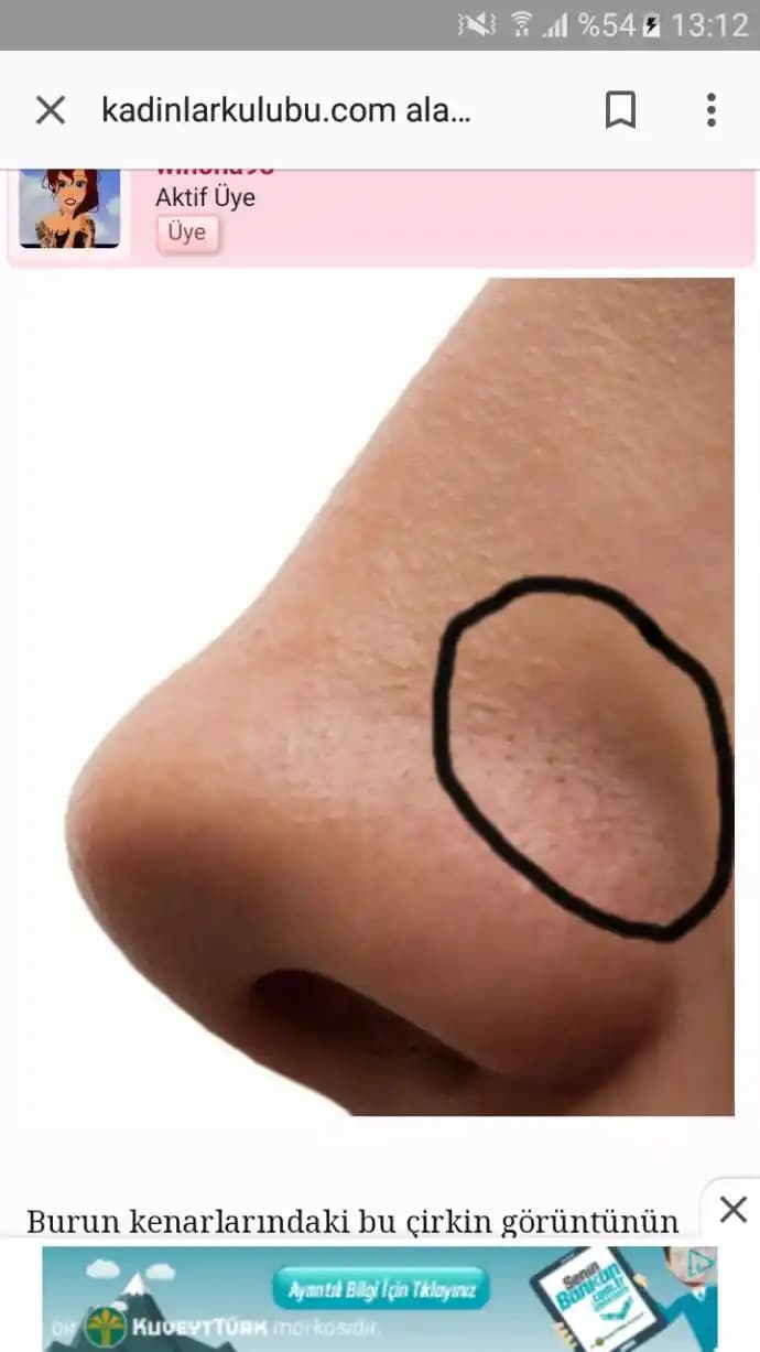 Burun Kenarlarında Soyulmanın Nedenleri ve Etkili Kozmetik Çözüm Yöntemleri