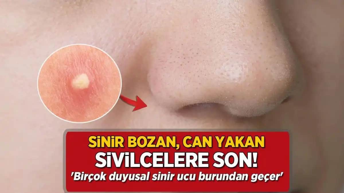 Burunda Ağrılı Sivilce Nedenleri ve Etkili Tedavi Yöntemleri Hakkında Kapsamlı Bilgi