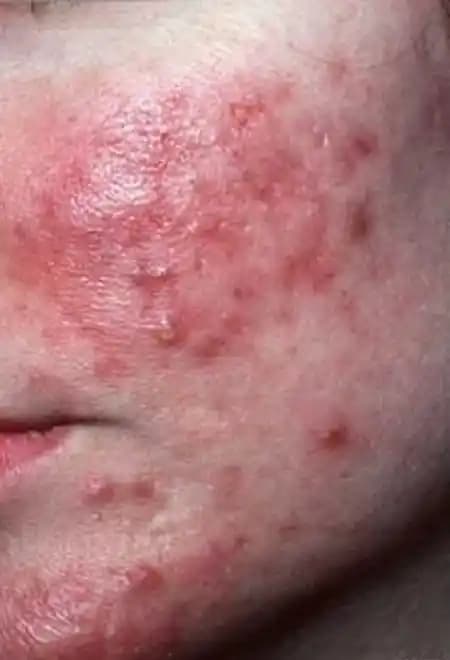 Burunda Gül Hastalığı: Belirtileri, Tedavi Yöntemleri ve Bakım İpuçları