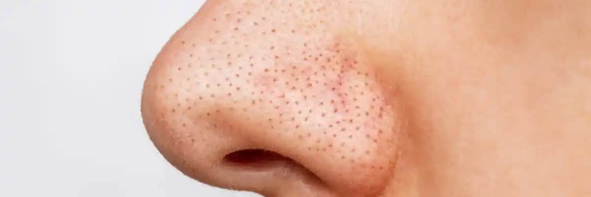 Burunda Kapalı Komedonler: Nedenleri, Belirtileri ve Etkili Tedavi Yöntemleri