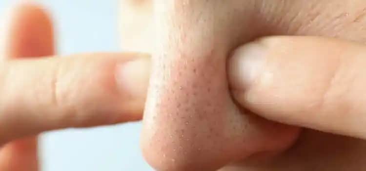 Burundaki Siyah Noktaları Doğru Yöntemlerle Temizleme ve Güvenli Bakım Rehberi