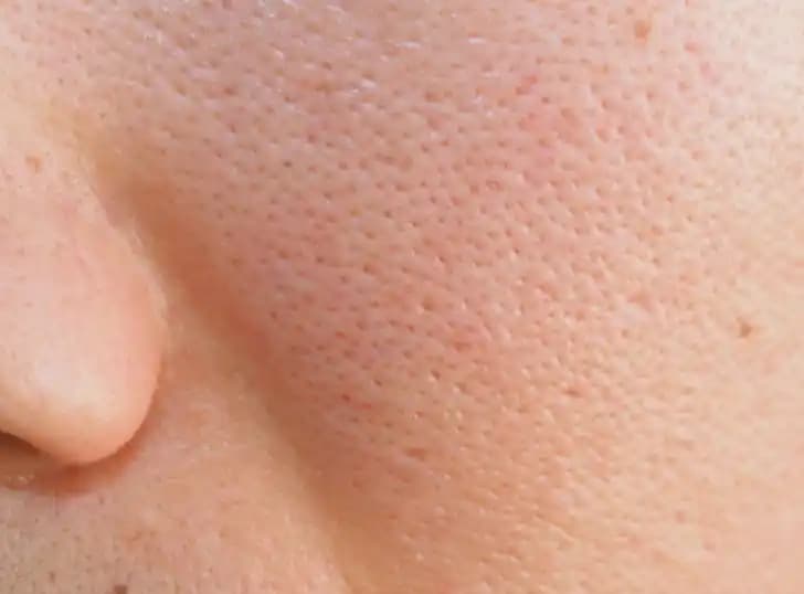 Büyük Gözenekleri Azaltma ve Cilt Görünümünü İyileştirme Yöntemleri