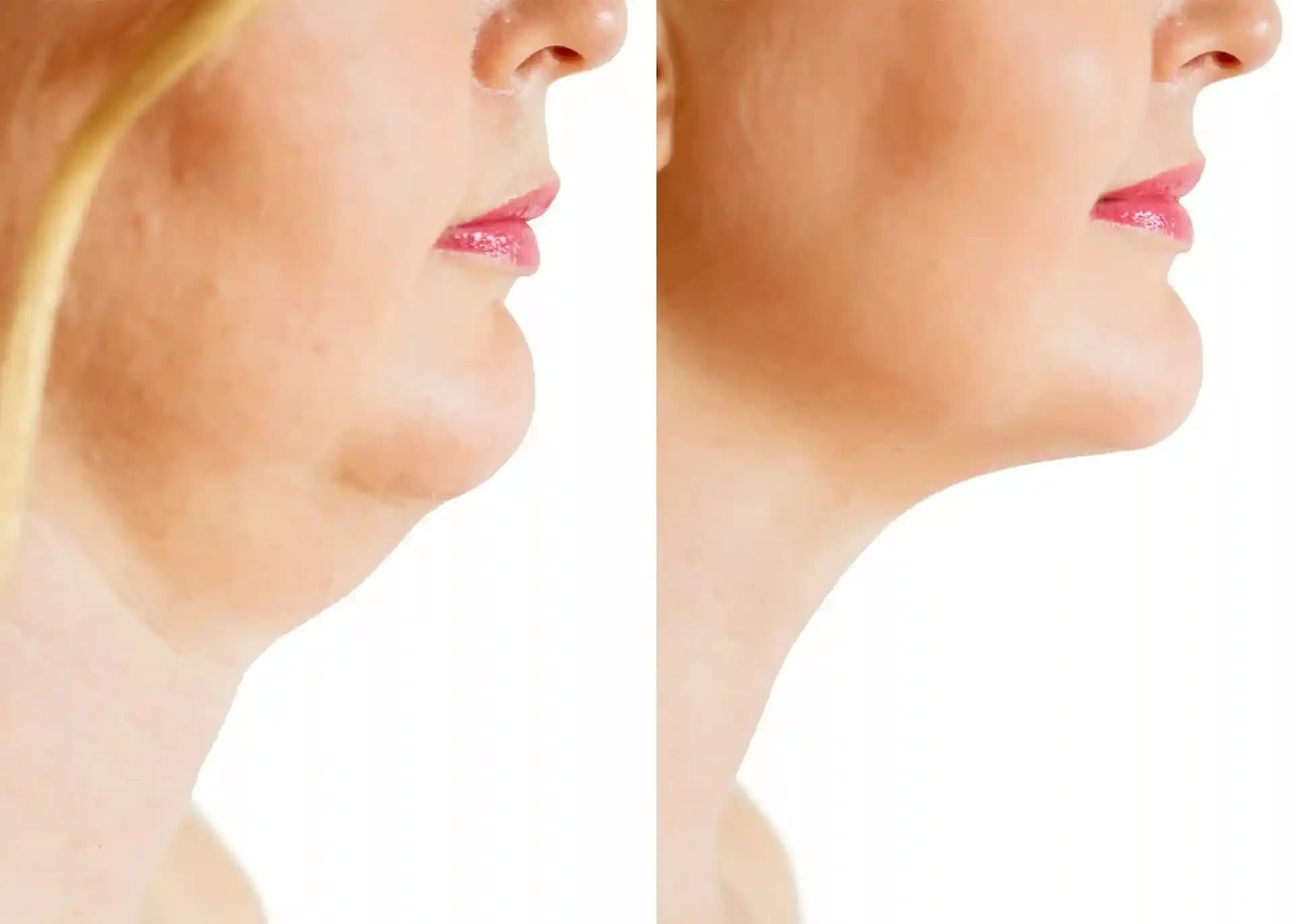 Buzla Gıdı Eritme Yöntemi: Güvenli ve Etkili Non-invaziv Estetik Çözüm