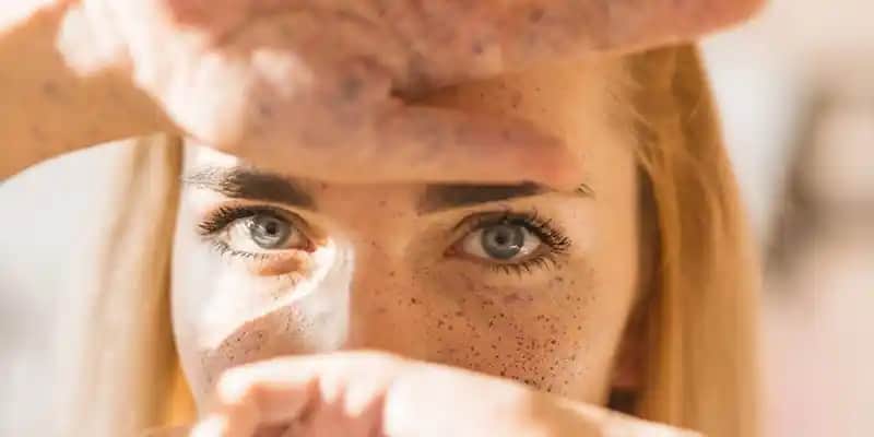 C vitamini ve güneş lekeleri ilişkisi: Doğru kullanım ve cilt sağlığı ipuçları