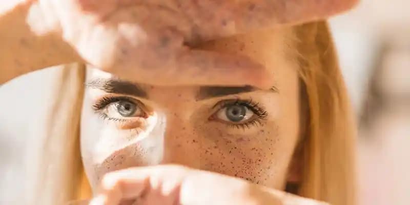 C vitamini ve güneş lekeleri ilişkisi: Doğru kullanım ve cilt sağlığı ipuçları