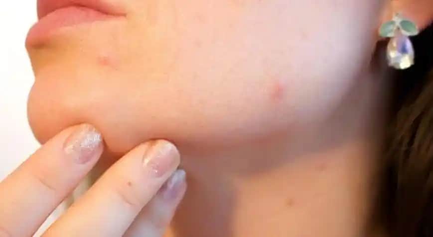 Çene Altı Sivilceleri Nedenleri ve Etkili Çözüm Yolları Hakkında Kapsamlı Bilgi