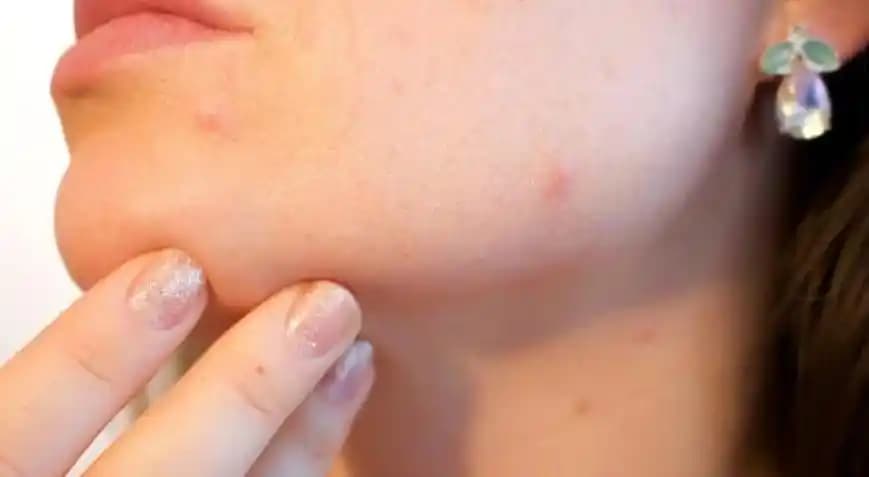 Çene Altı Sivilceleri Nedenleri ve Etkili Çözüm Yolları Hakkında Kapsamlı Bilgi