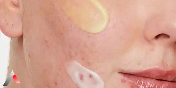 Çenede Komedon Nedir, Nasıl Önlenir ve Etkili Tedavi Yöntemleri Nelerdir