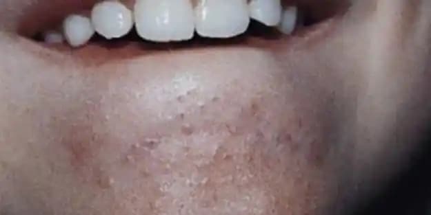 Çenede Siyah Noktalar ve Etkili Temizlik ile Gelişmiş Cilt Sağlığı Yöntemleri