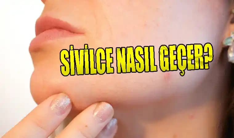 Çenedeki Sivilce Lekeleri Nasıl Geçer: Nedenleri ve Etkili Çözüm Yöntemleri