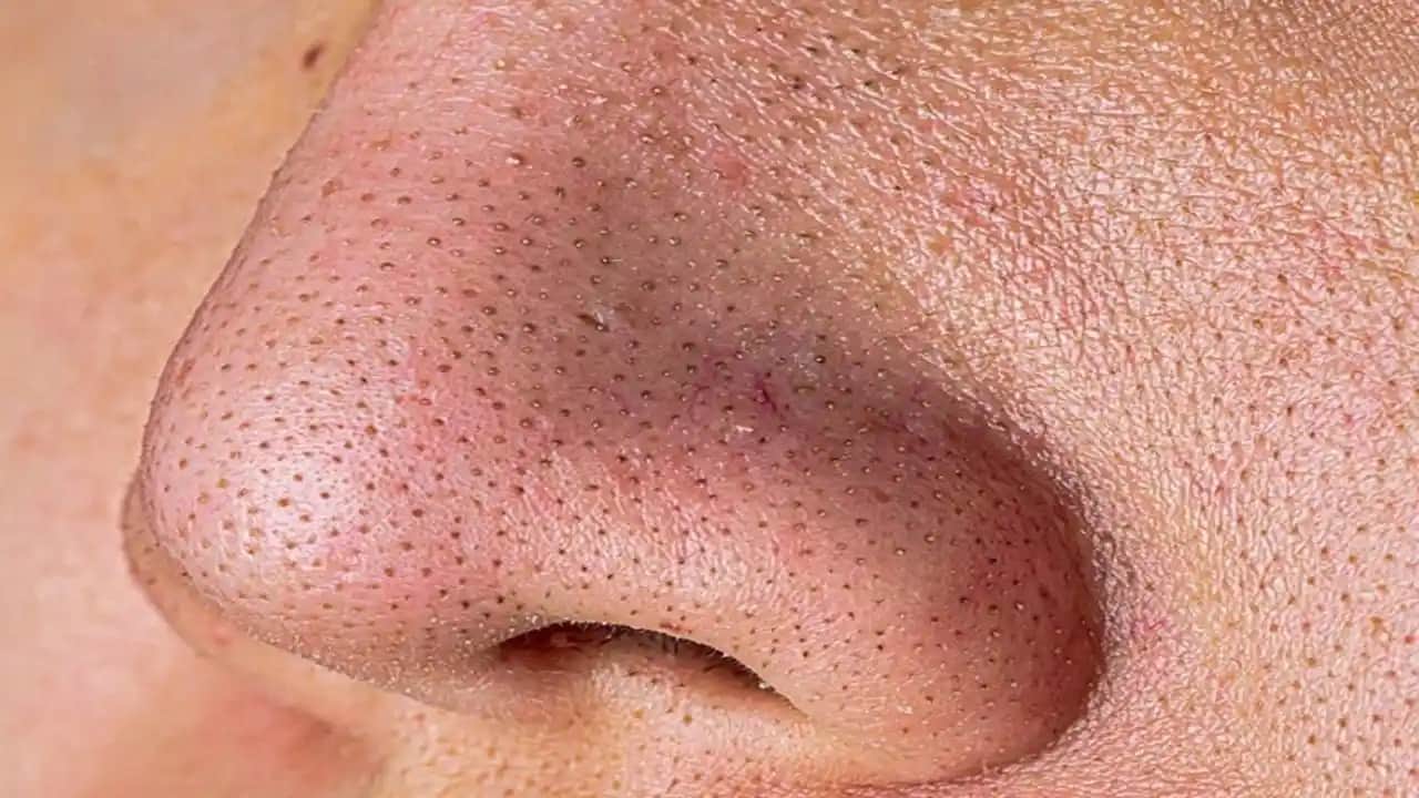 Çenedeki Siyah Noktalar Nasıl Geçer: Etkili Yöntemler ve Doğal Çözümler