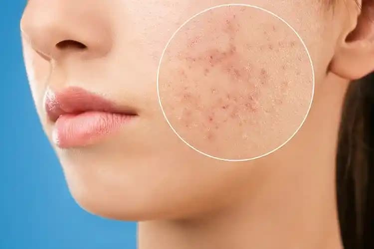 Çıkmak Üzere Olan Sivilceler ve Cilt Sağlığını Koruma Yöntemleri Rehberi