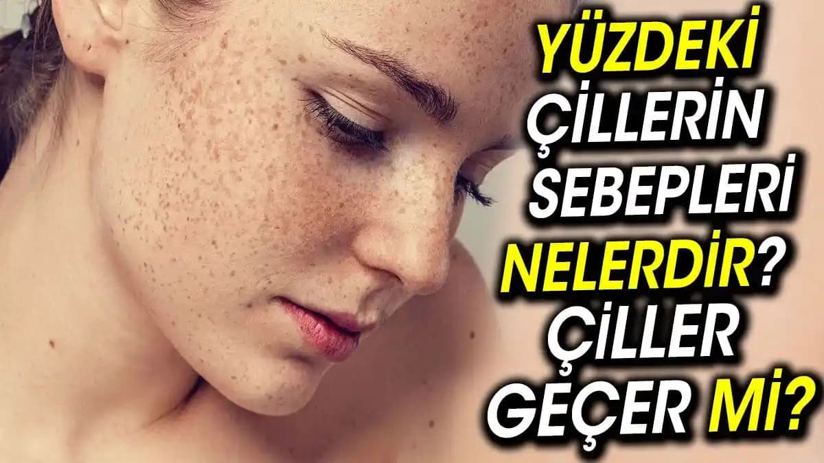 Çiller Geçer Mi? Cilt Sağlığı ve Güzellik Üzerine Detaylı Bilgi