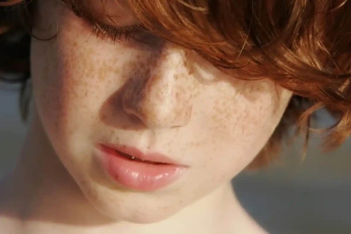 Çillere Karşı Kalıcı ve Etkili Çözüm Yolları: Güzel ve Doğal Bir Cilt İçin Rehber