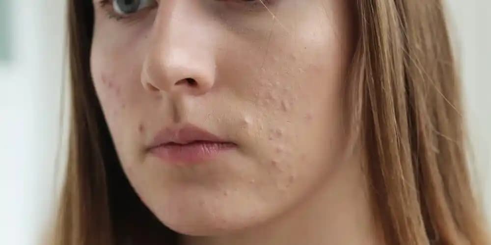 Cilt Aknesi Nedir, Nedenleri ve Etkili Tedavi Yöntemleri Hakkında Kapsamlı Bilgi
