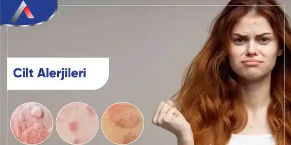 Cilt Alerjileri ve Kozmetik Ürünlerle Etkileşimleri: Bilmeniz Gerekenler