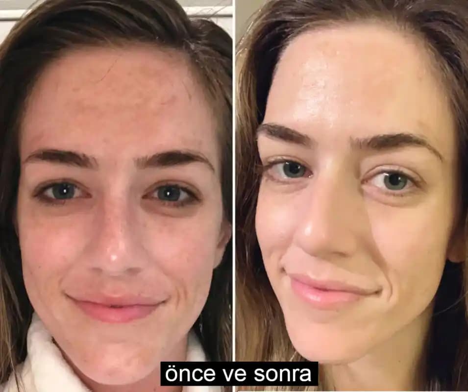 Cilt Bakımında Öncesi ve Sonrası: Sağlıklı ve Parlak Bir Cilt İçin Rehber