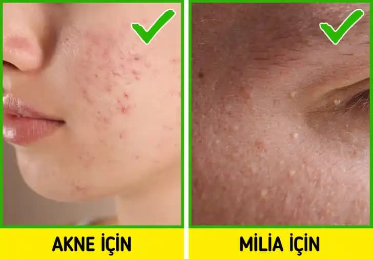 Cilt Kabarcıkları Nedenleri ve Etkili Çözüm Yolları Hakkında Kapsamlı Bilgi