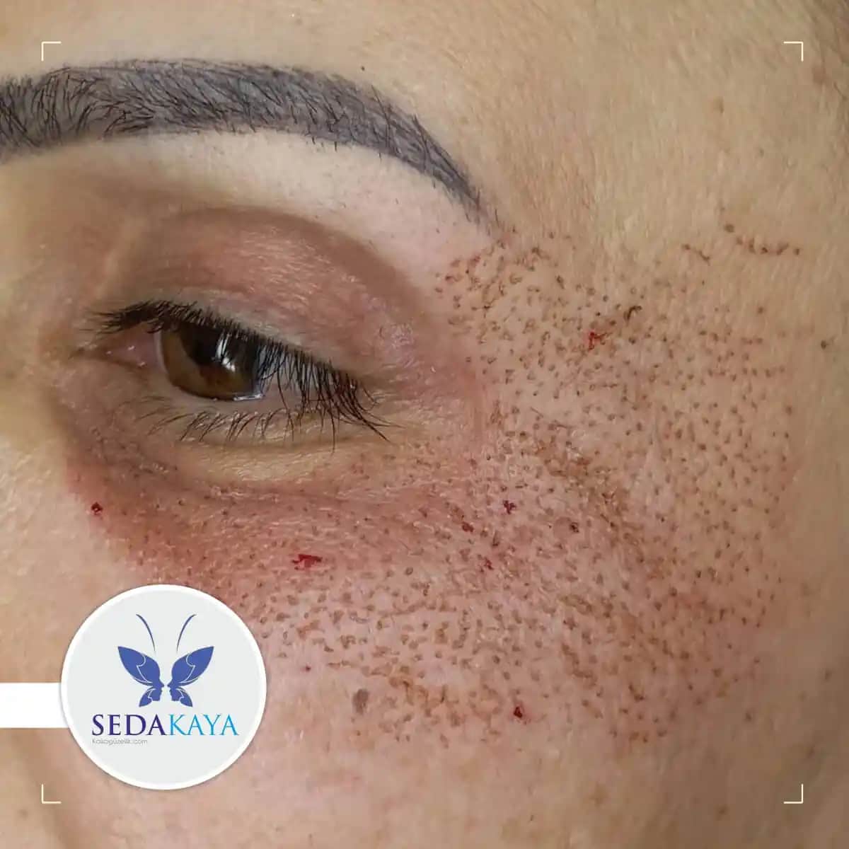 Cilt Kabuklanmasına Karşı Kapsamlı Rehber: Nedenleri, Çözüm Yolları ve Önleyici İpuçları