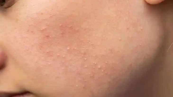 Cilt Komedonları Nedir Nasıl Giderilir ve En Etkili Çözüm Yolları