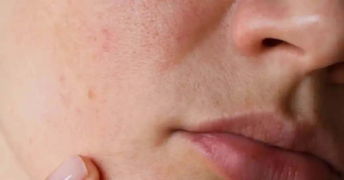 Cilt Lekeleri Türleri ve Uygun Bakım Yöntemleri Hakkında Detaylı Bilgi