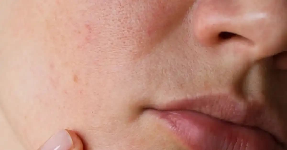 Cilt Lekeleri Türleri ve Uygun Bakım Yöntemleri Hakkında Detaylı Bilgi