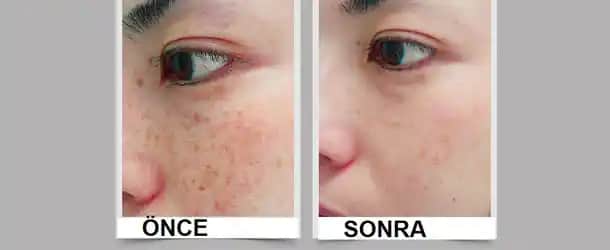 Cilt Pigmentasyonu Nedir, Yöntemleri ve Güvenlik İpuçları