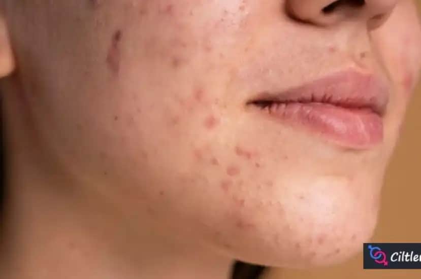 Ciltte Çıkan Yaraların Nedenleri ve Kozmetik Yaklaşımlarla İzlerin Azaltılması