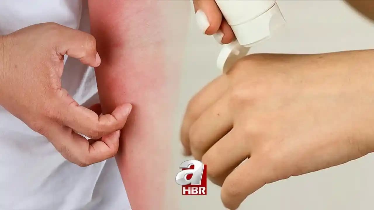 Ciltte Geçmeyen Kızarıklık Nedenleri ve Etkili Tedavi Yöntemleri