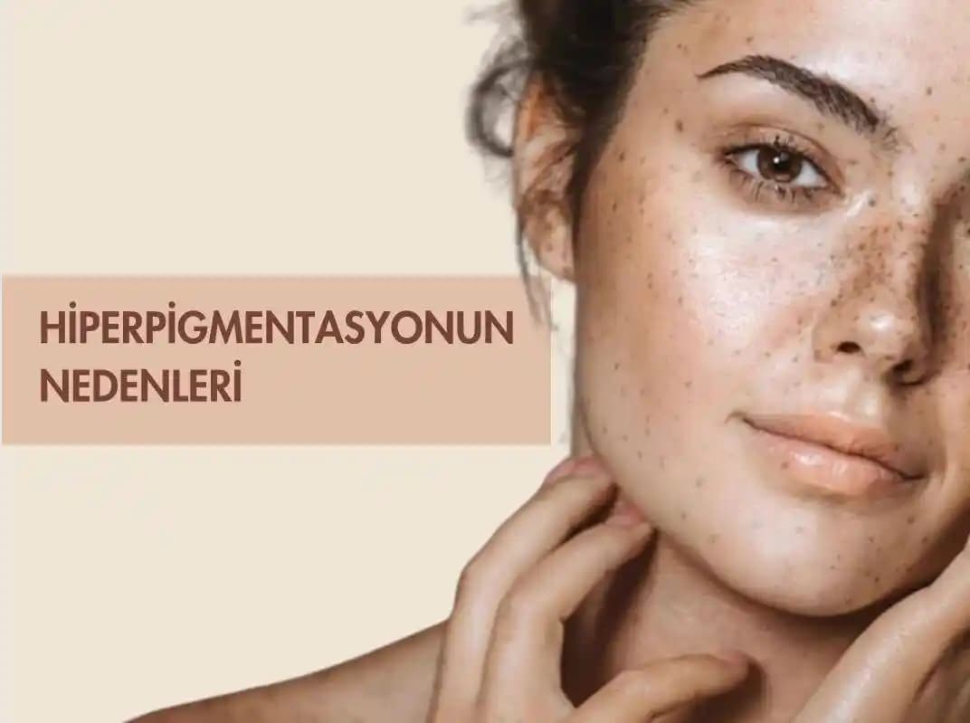 Ciltte Hiperpigmentasyon Nedenleri, Tedavi Yöntemleri ve Bakım İpuçları