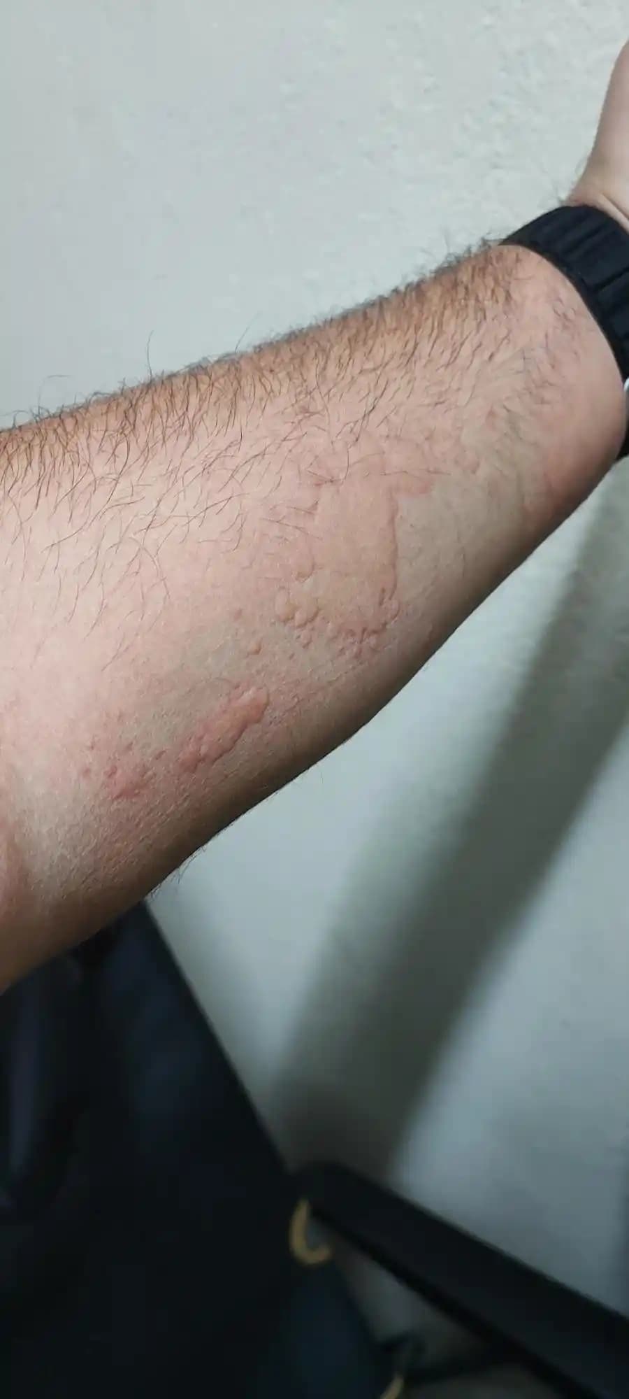 Ciltte Kasıntı ve Kızarıklık Nedenleri, Önlemleri ve Çözüm Yolları