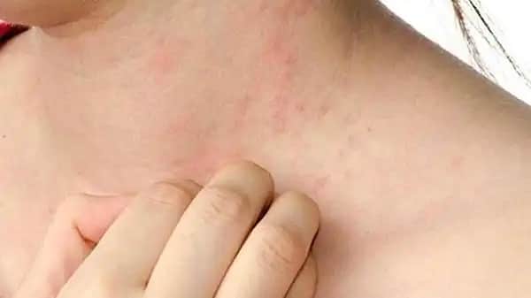 Ciltte Kaşıntı ve Yara Sorunlarının Kozmetik Perspektiften Nedenleri ve Çözüm Yolları