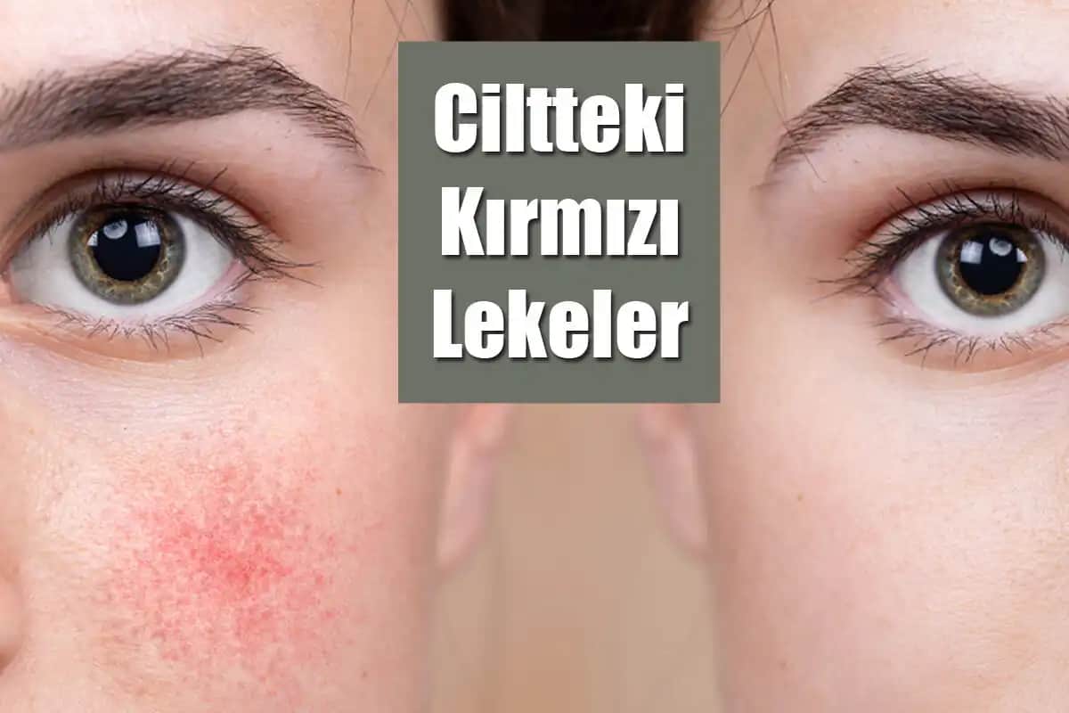 Ciltte Kırmızı Lekelerin Nedenleri, Belirtileri ve Etkili Çözüm Yolları