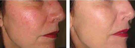 Ciltte Kızarıklık ve Yanma: Doğru Kozmetik Bakım Yaklaşımları ve Çözümler