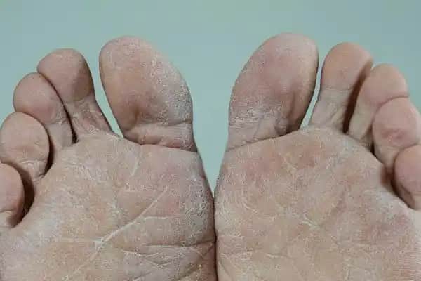 Ciltte Mantar Belirtileri ve Korunma Yöntemleri Hakkında Kapsamlı Bilgi