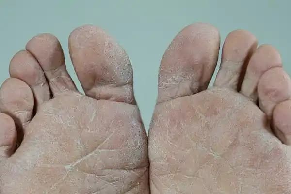 Ciltte Mantar Belirtileri ve Korunma Yöntemleri Hakkında Kapsamlı Bilgi